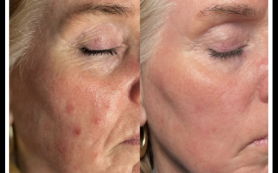 Calm Is the New Collagen: Meet TSC, the Molecule Behind Epicutis’s Quiet Power
