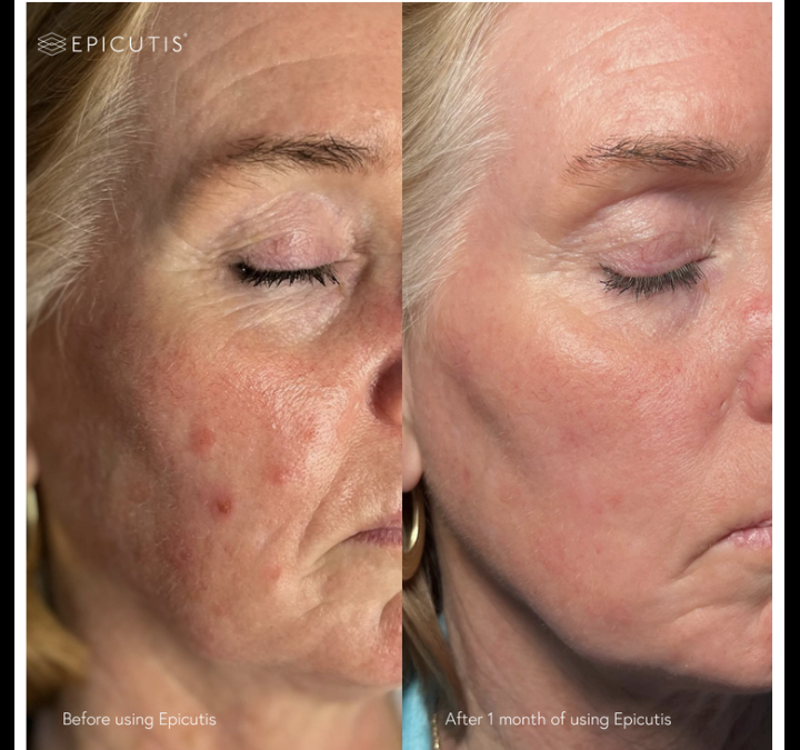 Calm Is the New Collagen: Meet TSC, the Molecule Behind Epicutis’s Quiet Power