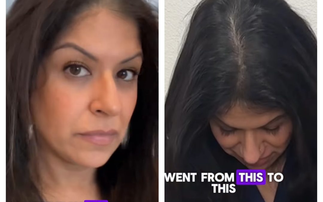 The Crown Royale Protocol: Restoring Hair Loss After GLP-1 Weight Loss